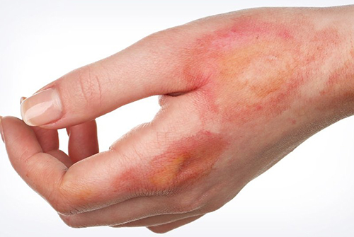 დასიება, სიმსივნე